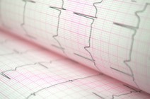 EKG-Kurve